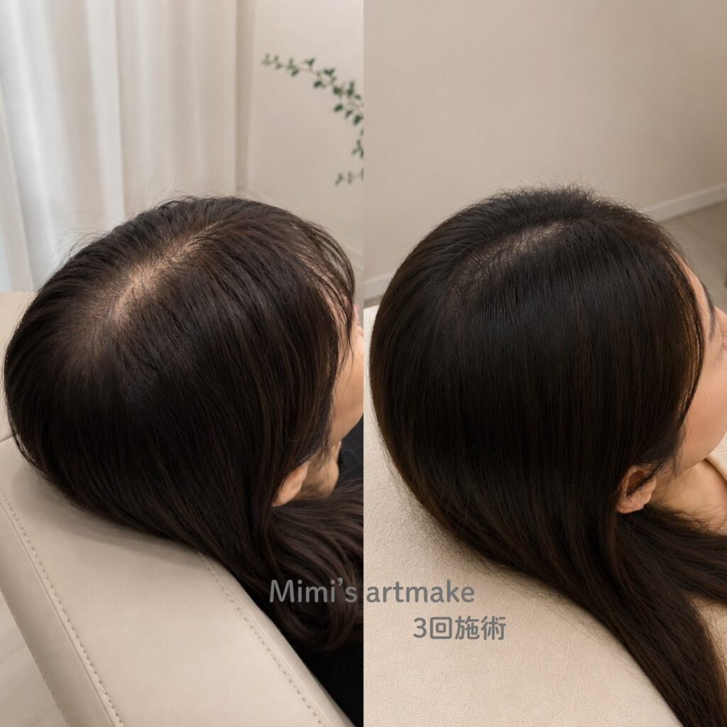 頭皮アートメイクの施術前後(Before / After)