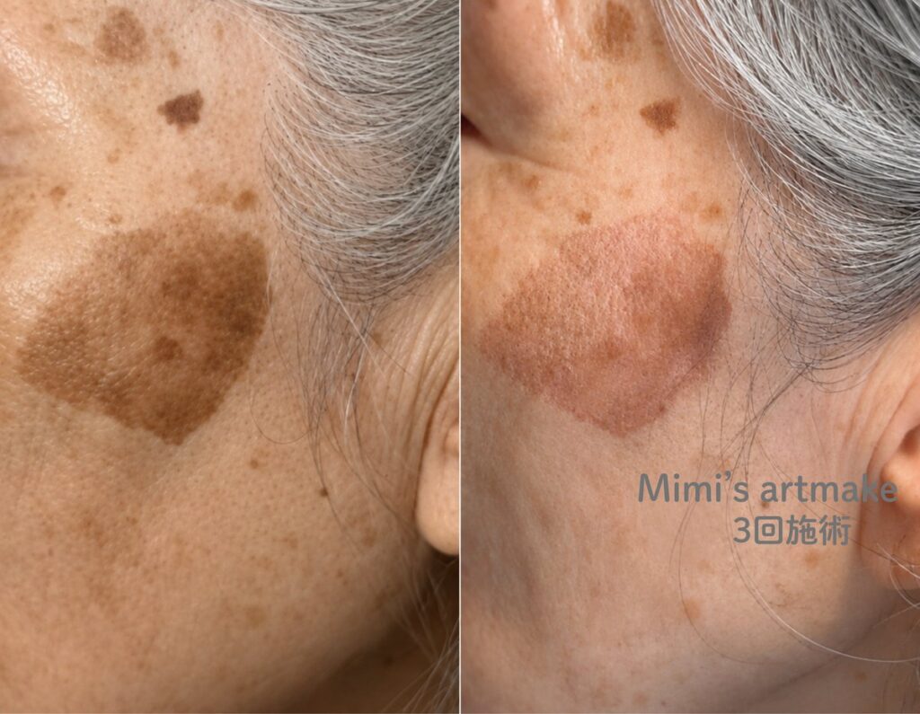 シミ消しの施術前後(Before / After) 3回施術